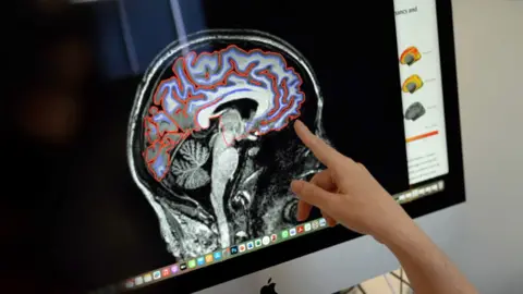 Brain scan showing grey matter