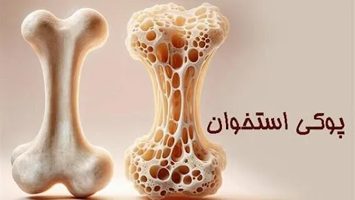 پوکی استخوان؛ قاتل خاموش و راهکارهای پیشگیری و درمان